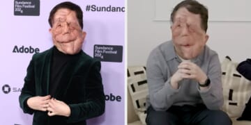 A Different Man's Adam Pearson On Actors With Disabilites